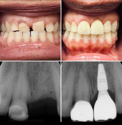 The patient came in with one concern (replacing the ugly denture tooth) and walked out with a gorgeous smile.