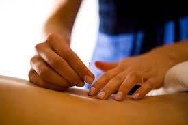 Acupuncture