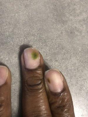 Fungus on nails