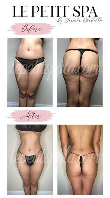 Before after body sculpting after 4 treatments using wood and ultrasonic cavitation.