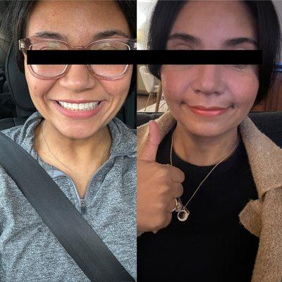 Smile is different due to swelling/limited upper lip mobility post op (which is to be expected and anticipated to resolve in coming weeks).