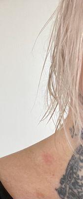 Red mark on my neck from being yanked back so hard on the bowl.