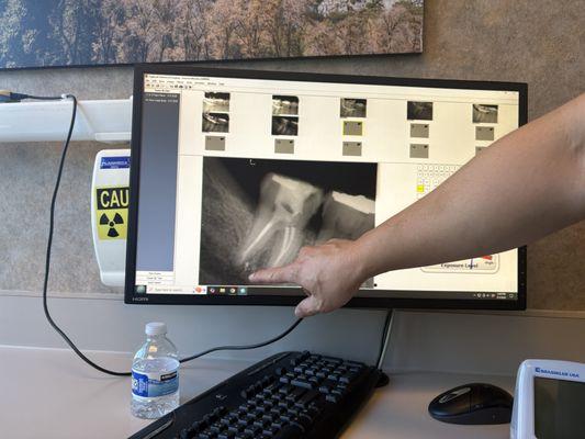 Dr. Le, explaining what he has done, post procedure.