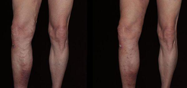 Before (left) & After (right) of varicose vein treatment.