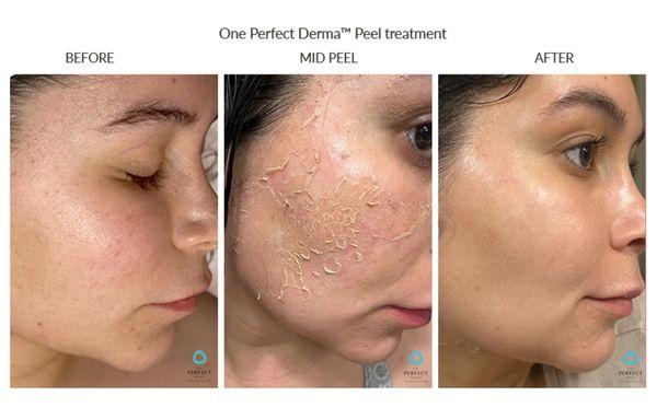 The Perfect Derma Peel