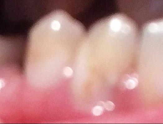 Close-up of the 2 fillings. Super bright white filling too. Was told to smoke and drink coffee to make it look normal!