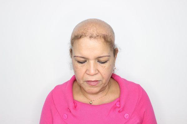 Antes prótesis capilar femenina