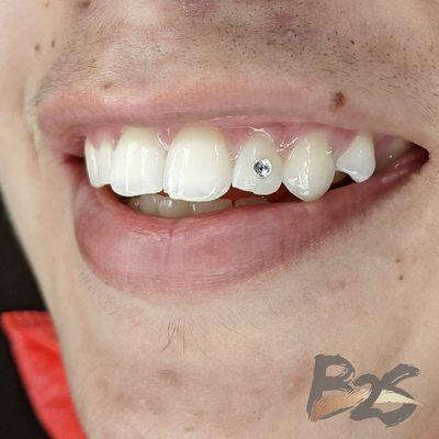 Tooth gems. Add sparkle to your smile ! No drill & no damage to the enamel. Reversible !