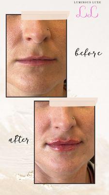 Luminous Luxe Mobile Injector