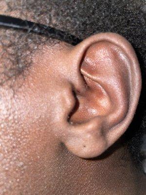 A view of how they just got the skin of my daith and not any cartilage