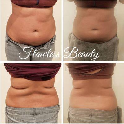 Before and After VelaShape