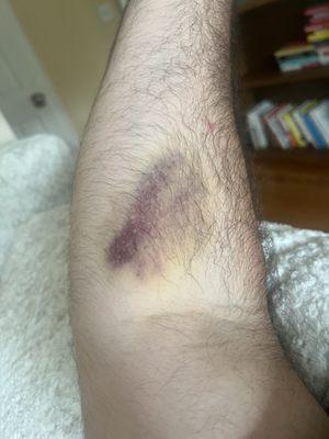 Nasty bruise from blood draw