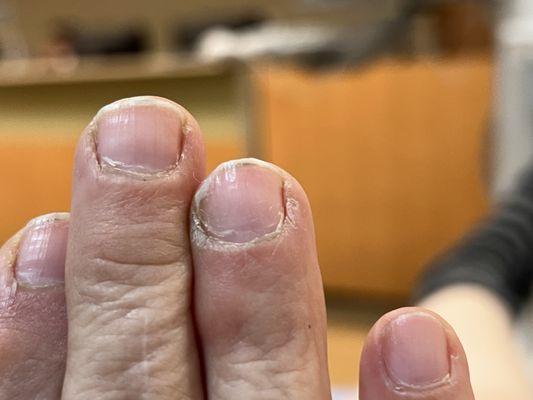 My progressing mold illness. Green wasted cuticles and under nails. Have white and brown filaments. Nails splitting in green layers.