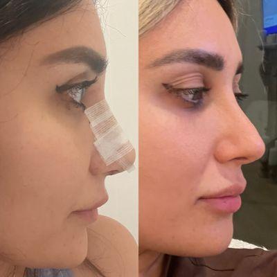 Revision rhinoplasty