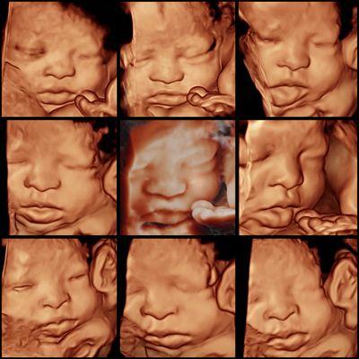 3D/5D HD Ultrasound of baby girl.