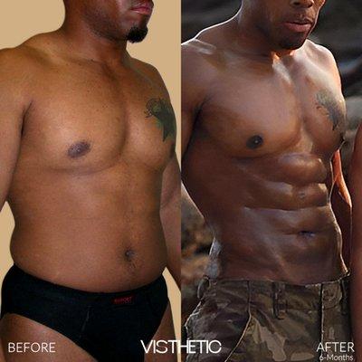 Liposculpting (VASERLipo) | Right Angle | 6-Month Results