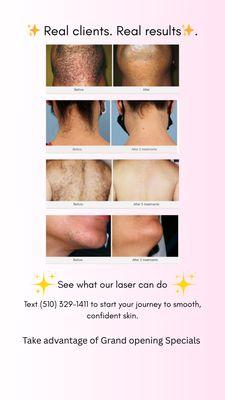 With results this great, WHY WAIT!!! Start your laser journey today! Book now!