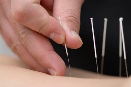 What can you say? Acupuncture has stood the test of time as a unique way to access the body's self-healing powers ... naturally!