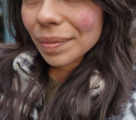 Redness/ stress acne BEFORE facial