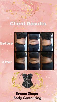 Dream Shape Body Contouring