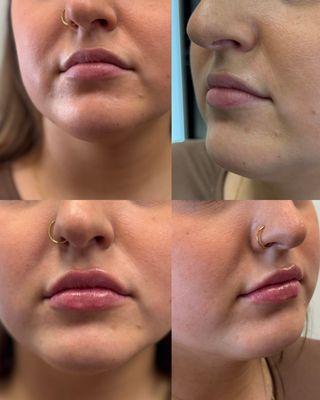 Before and after half syringe of filler in the lips