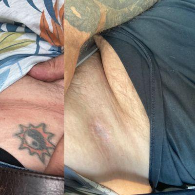 EradiTatt Tattoo Removal - Orlando