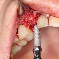 GoldenDent - Dental Forceps