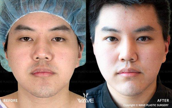 Wave Plastic Surgery & Aesthetic Laser Center: Costa Mesa
