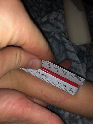 Bite mark found on my childs arm after I picked him up. No incident report and no one knows what happened. Now he says "teacher bite my arm"