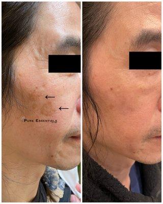 Age / Sun Spot Removal. Left photo: removed two large skin growths on right cheek Feb '22. Right photo: after photo taken by client Feb '23
