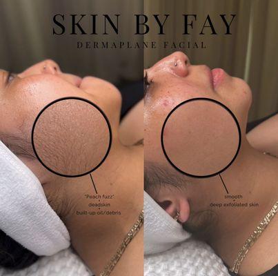 Dermaplane Facial before & after