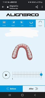 2 large gaps on both sides of his front teeth.