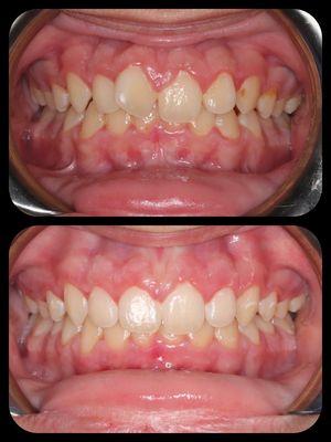 Invisalign treatment for one of our teen patients