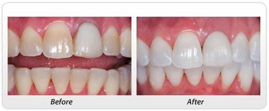 Before and After KOR Whitening