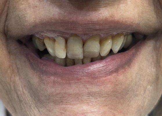 before installing upper bridge