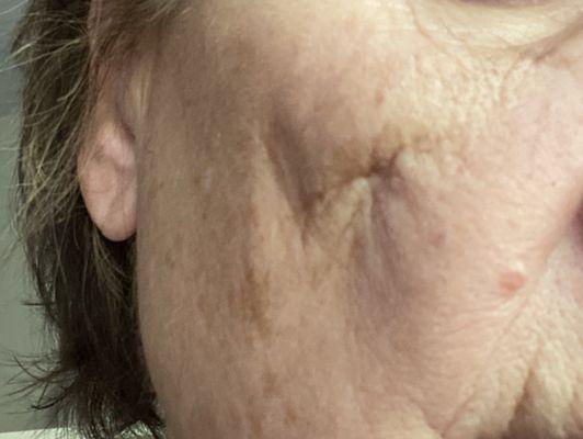 Still experiencing tenderness and dimpling on my right cheek  after a fall.