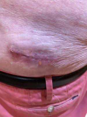 August 12_25 redness and drainage from Spinal Cord Stimulator implant Dr. David Neckman, Alliance Spine & Pain.