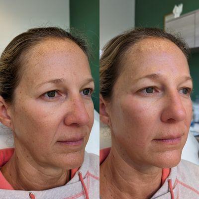 Face Rejuvenation using Dermal filler (cheeks and smile lines)