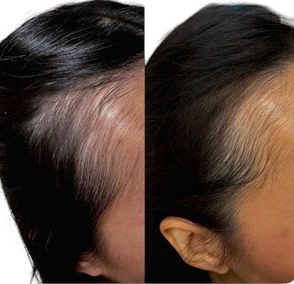 Prp hair restoration services