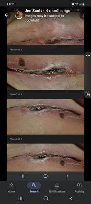 Dead tissue of stomach after tummy tuck. Won't return calls or text.