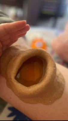 A traditional Ayurvedic knee basti, warm medicated oil held in place to soothe inflammation, ease pain, and deeply nourish the joints.