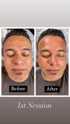 Microneedling for Men