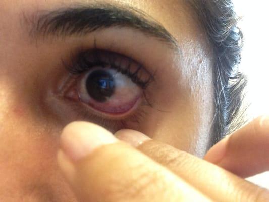 the not so fun aftermath...