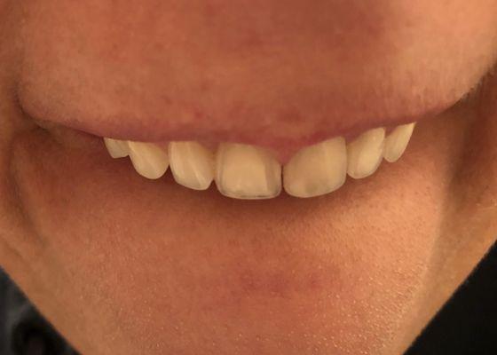 Photo AFTER Valentina shaved enamel & tooth structure off the back, front & in betw my central incisors! Yellow NOW dentin exposure!