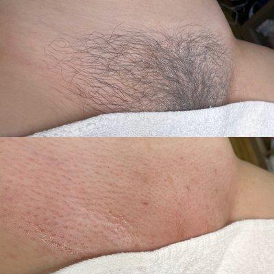 Before & After Brazilian Wax