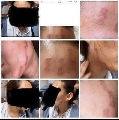 They deny they burned customer's face, this is the burning evidence.