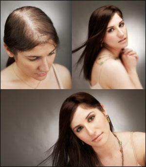 Alopecia, female patterned balding, we can help! Ask for longer fuller natural looking hair!