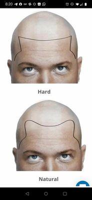 Scalp Micropigmention