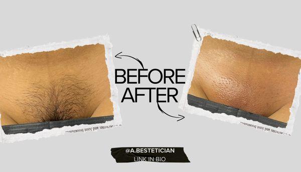 Before and After of a Brazilian Wax