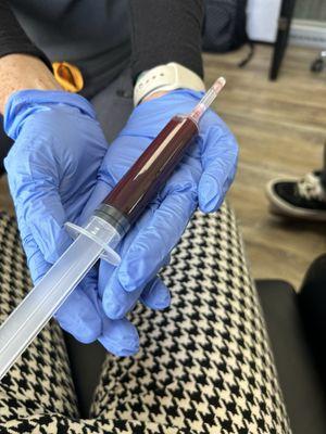 My old untreated blood